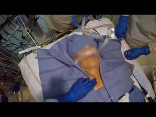 Percutaneous Tracheostomy
