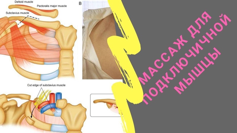 Therapeutic Massage for subclavius