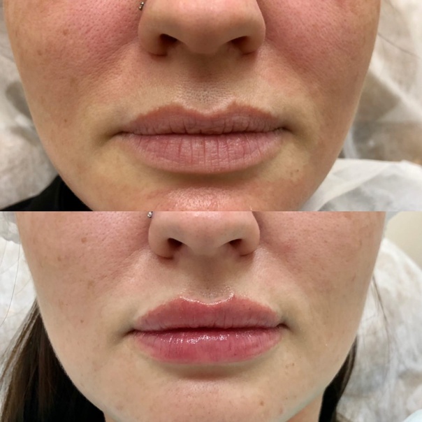 Линейка медицинских препаратов Stylage (Vivacy, Франция) - IdealMed